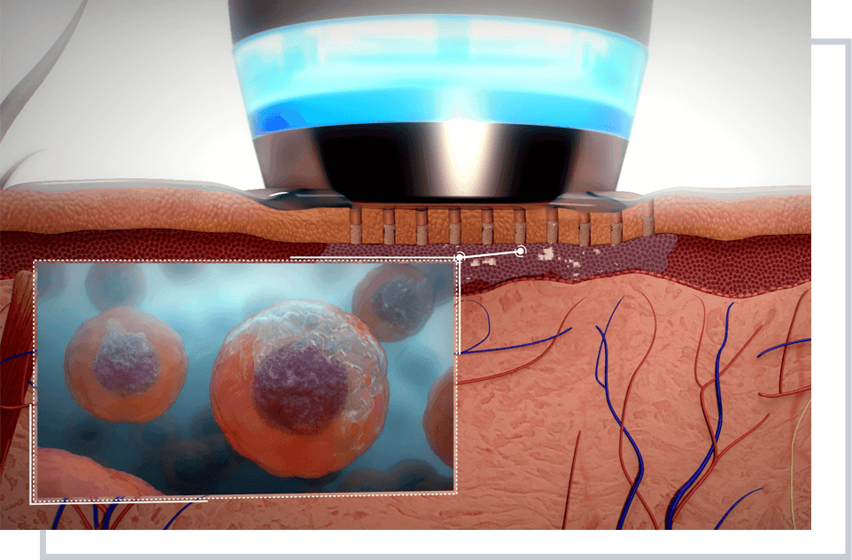 Apollo Duet | Multifunctional RF Skin Therapy System - RVTmed.store