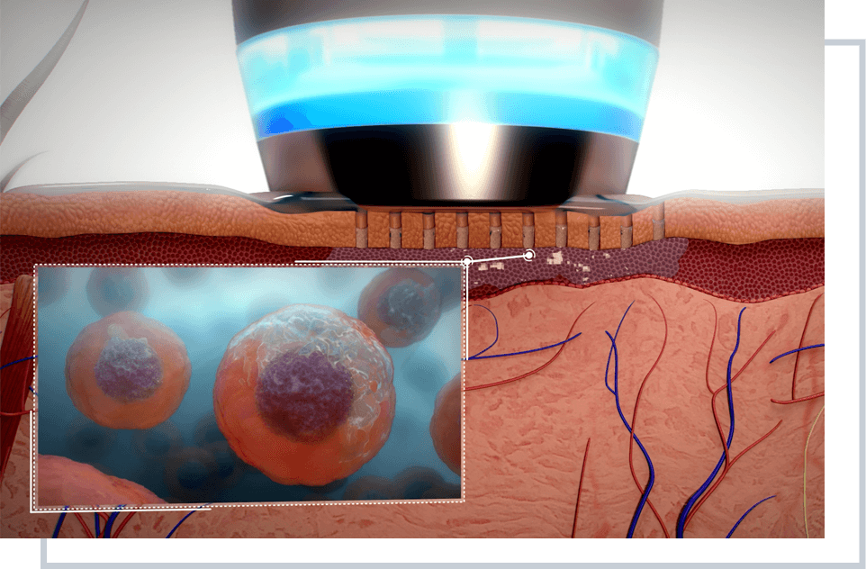 Apollo Duet | Multifunctional RF Skin Therapy System
