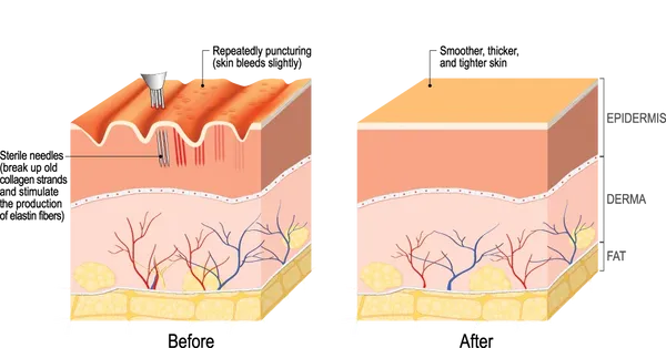 Radiance RF Microneedling Machine | Advanced RF Skin Rejuvenation Device
