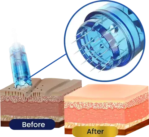 Cartridges - NanoPen PRO