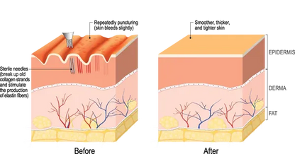 Radiance RF Microneedling Machine | Advanced RF Skin Rejuvenation Device