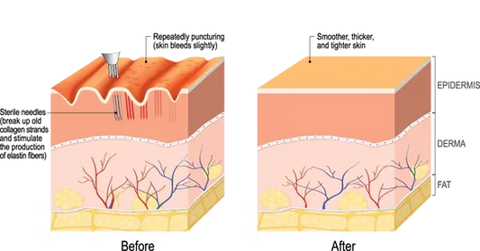 Radiance RF Microneedling Machine | Advanced RF Skin Rejuvenation Device